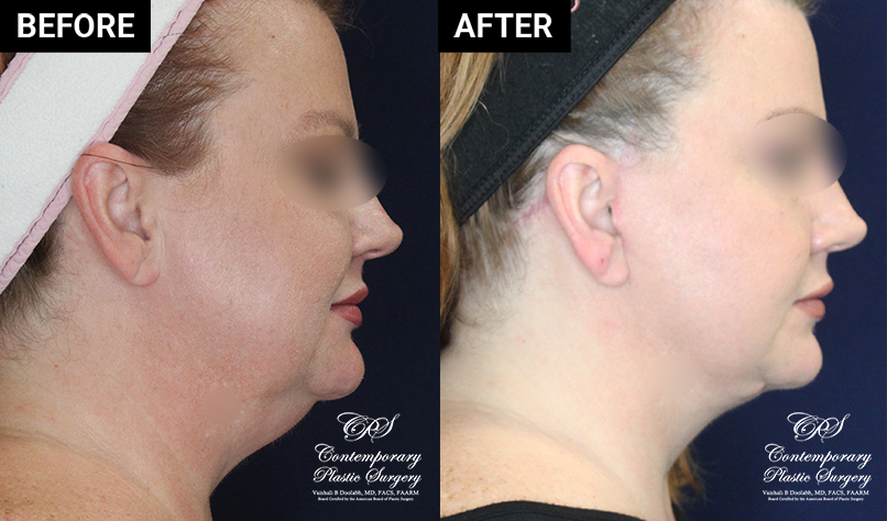 patient 19644 before and after results at Contemporary Plastic Surgery