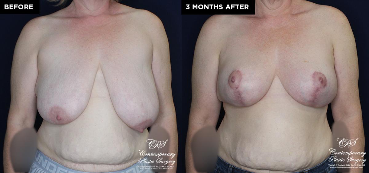 breast augmentation before and after results at Contemporary Plastic Surgery