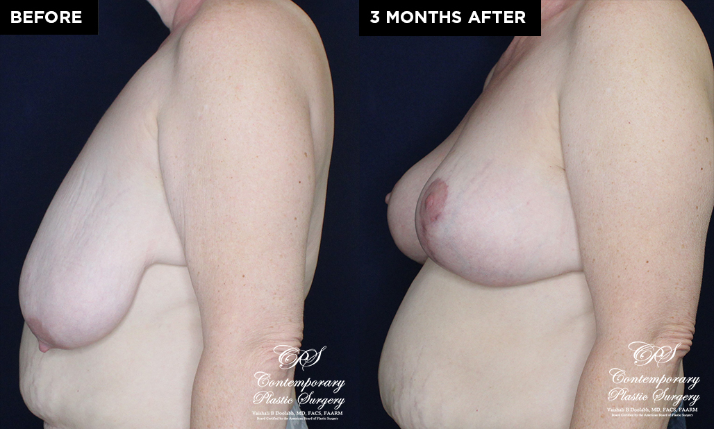 breast augmentation before and after results at Contemporary Plastic Surgery