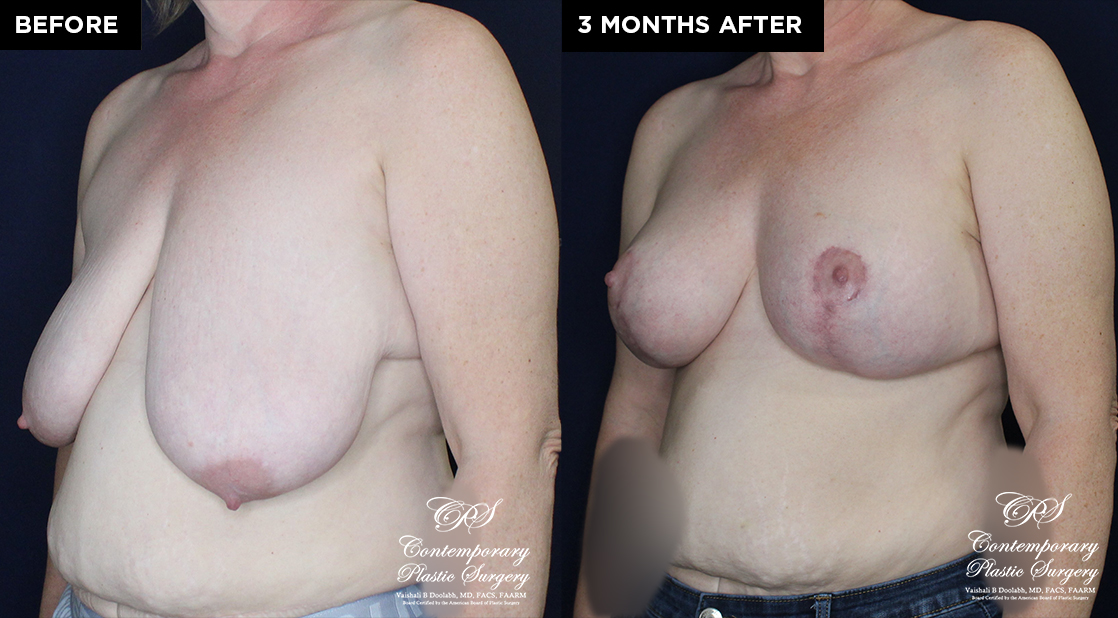 breast augmentation before and after results at Contemporary Plastic Surgery