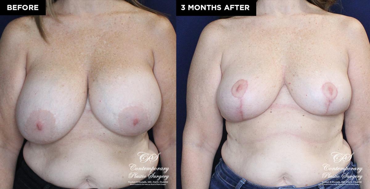 breast lift and implant removal 19692 before and after results at Contemporary Plastic Surgery