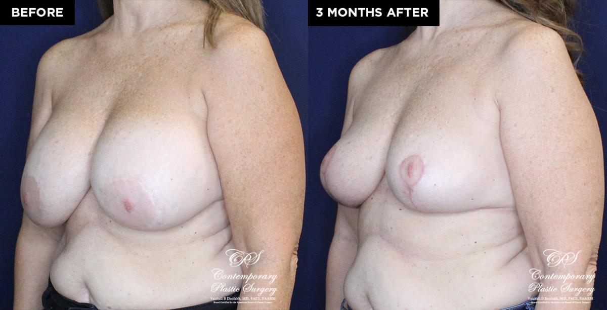 breast lift and implant removal 19692 before and after results at Contemporary Plastic Surgery