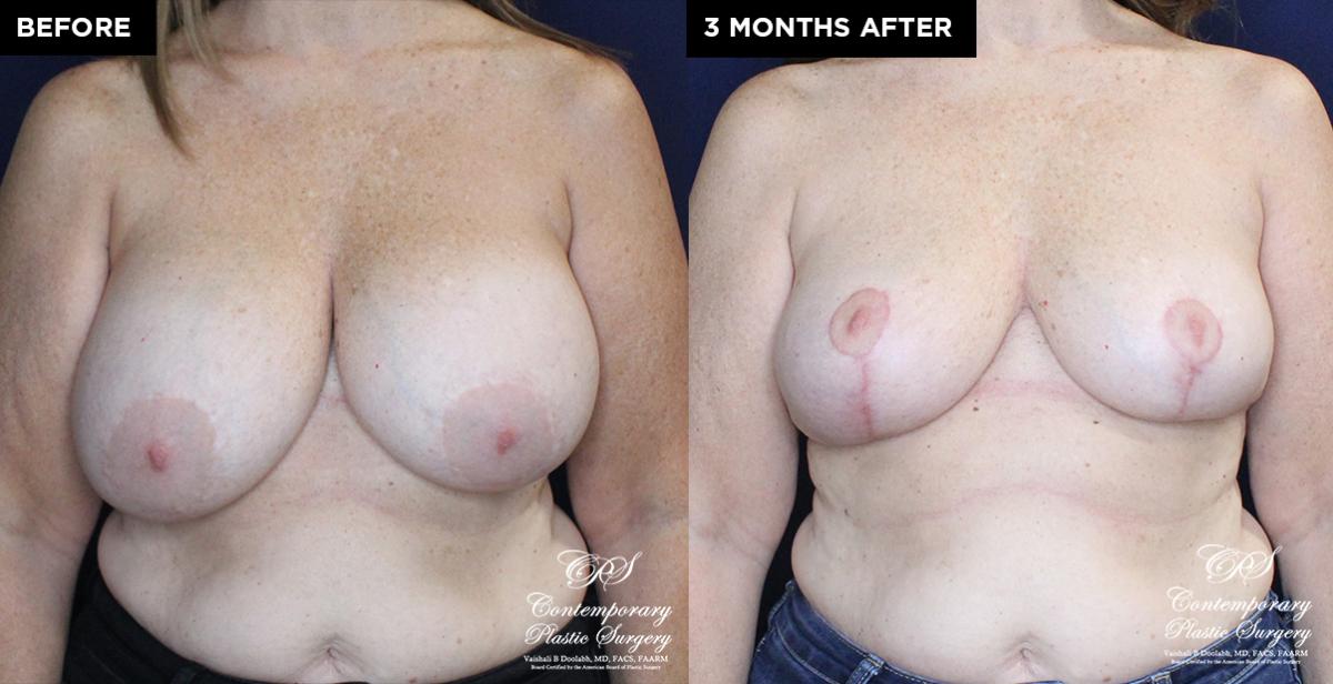 breast lift and implant replacement results at Contemporary Plastic Surgery