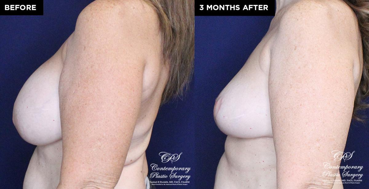 breast lift and implant replacement results at Contemporary Plastic Surgery