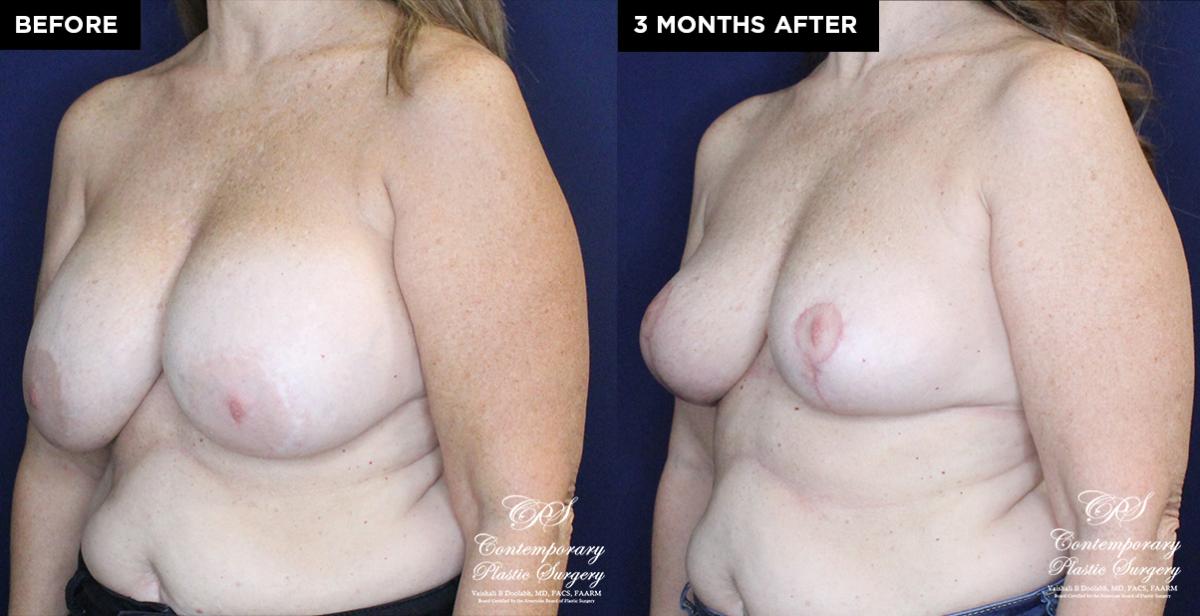 breast lift and implant replacement results at Contemporary Plastic Surgery