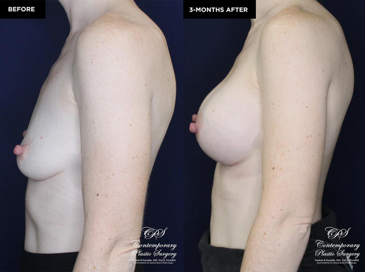 patient 19922 breast augmentation results at Contemporary Plastic Surgery