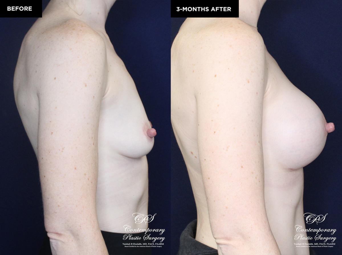 patient 19922 breast augmentation results at Contemporary Plastic Surgery