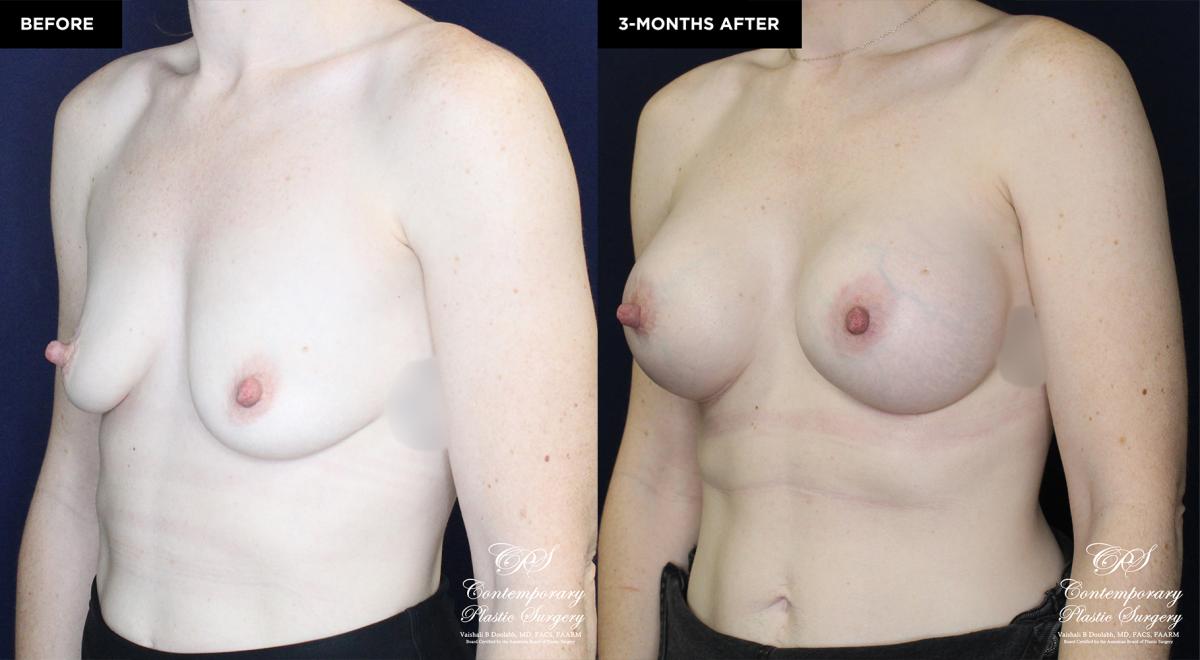 patient 19922 breast augmentation results at Contemporary Plastic Surgery