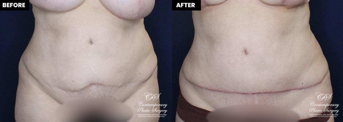 patient 19980 scar revision treatment before and after results at Contemporary Plastic Surgery