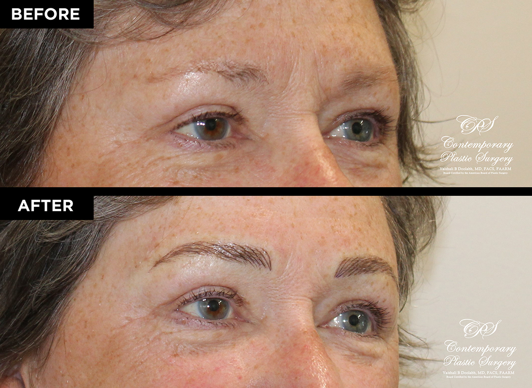 eyebrow micropigmentation patient 19993 before and after results at Contemporary Plastic Surgery