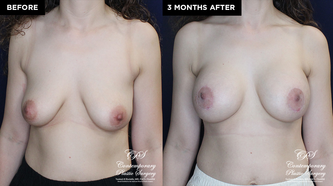 patient 20019 breast augmentation at Contemporary Plastic Surgery