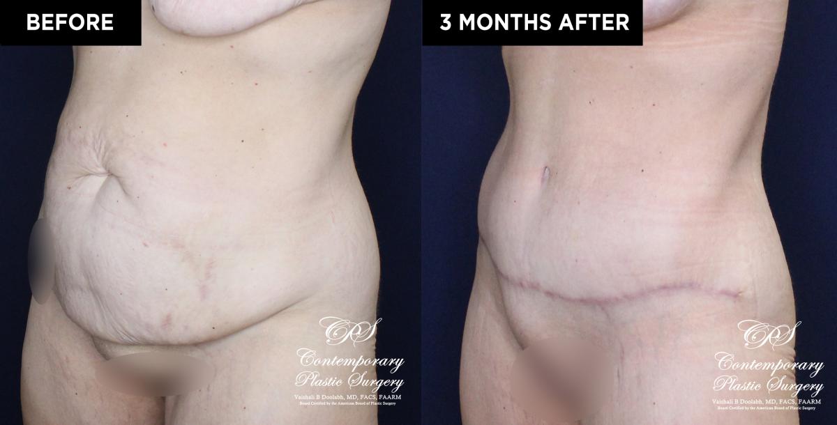 Patient 20030 abdominoplasty before and after results at Contemporary Plastic Surgery