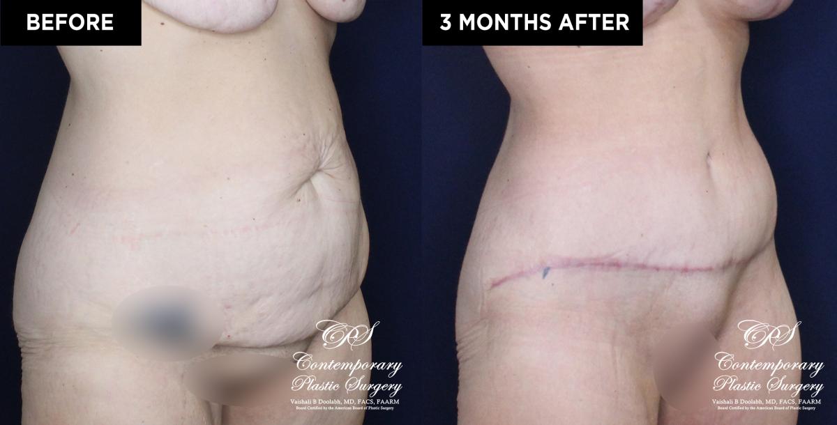 Patient 20030 abdominoplasty before and after results at Contemporary Plastic Surgery