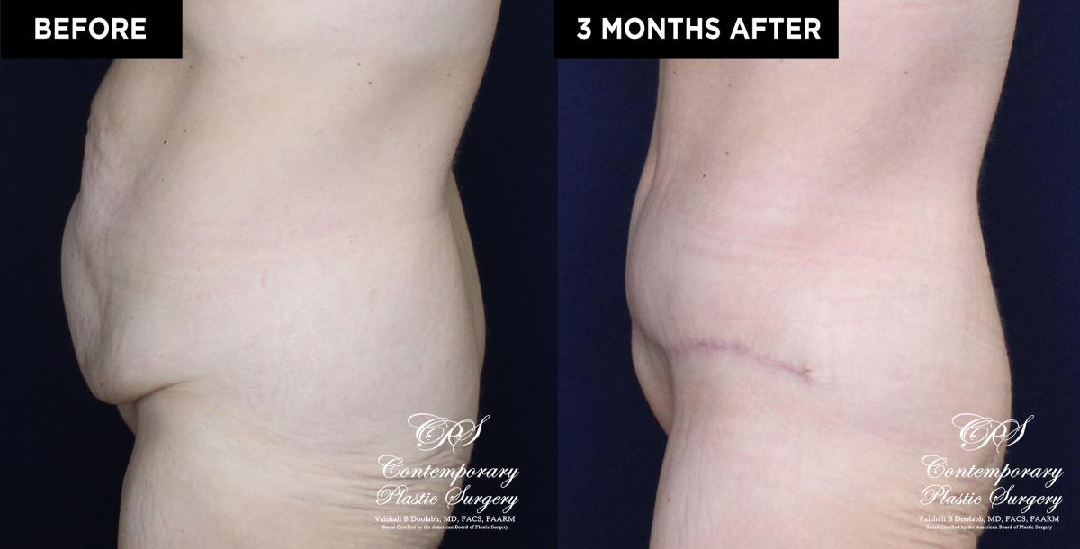 Patient 20030 abdominoplasty before and after results at Contemporary Plastic Surgery