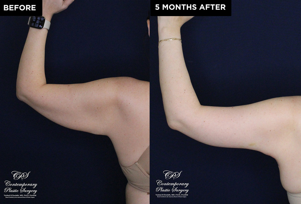 Patient 20074's arm lift before and after results at Contemporary Plastic Surgery