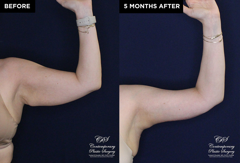 Patient 20074's arm lift before and after results at Contemporary Plastic Surgery