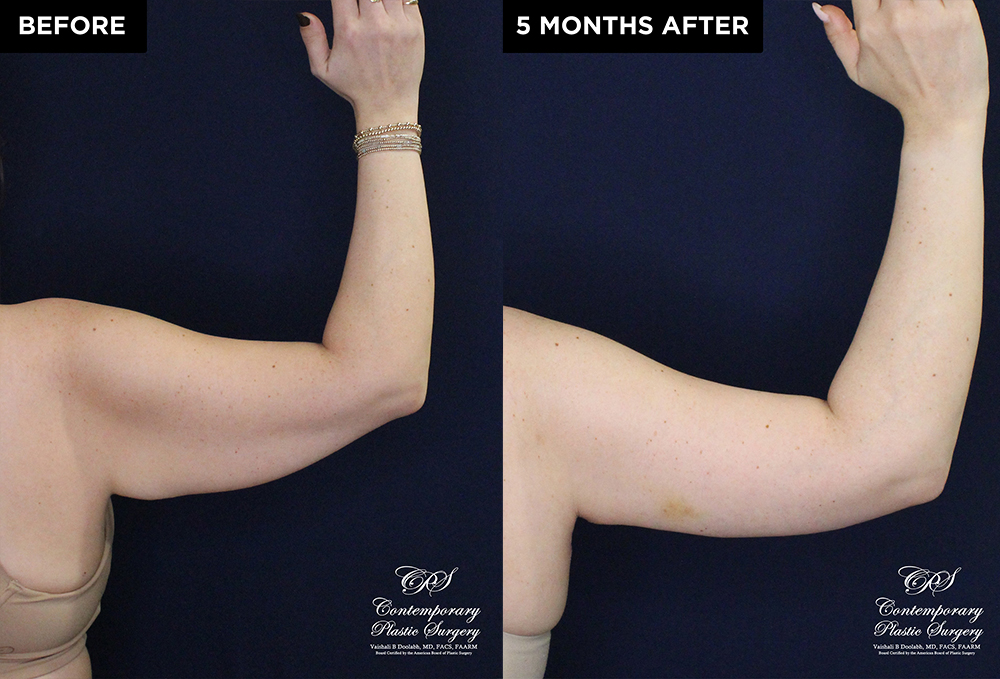 Patient 20074's arm lift before and after results at Contemporary Plastic Surgery