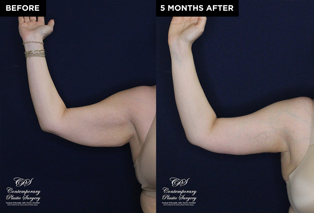 Patient 20074's arm lift before and after results at Contemporary Plastic Surgery