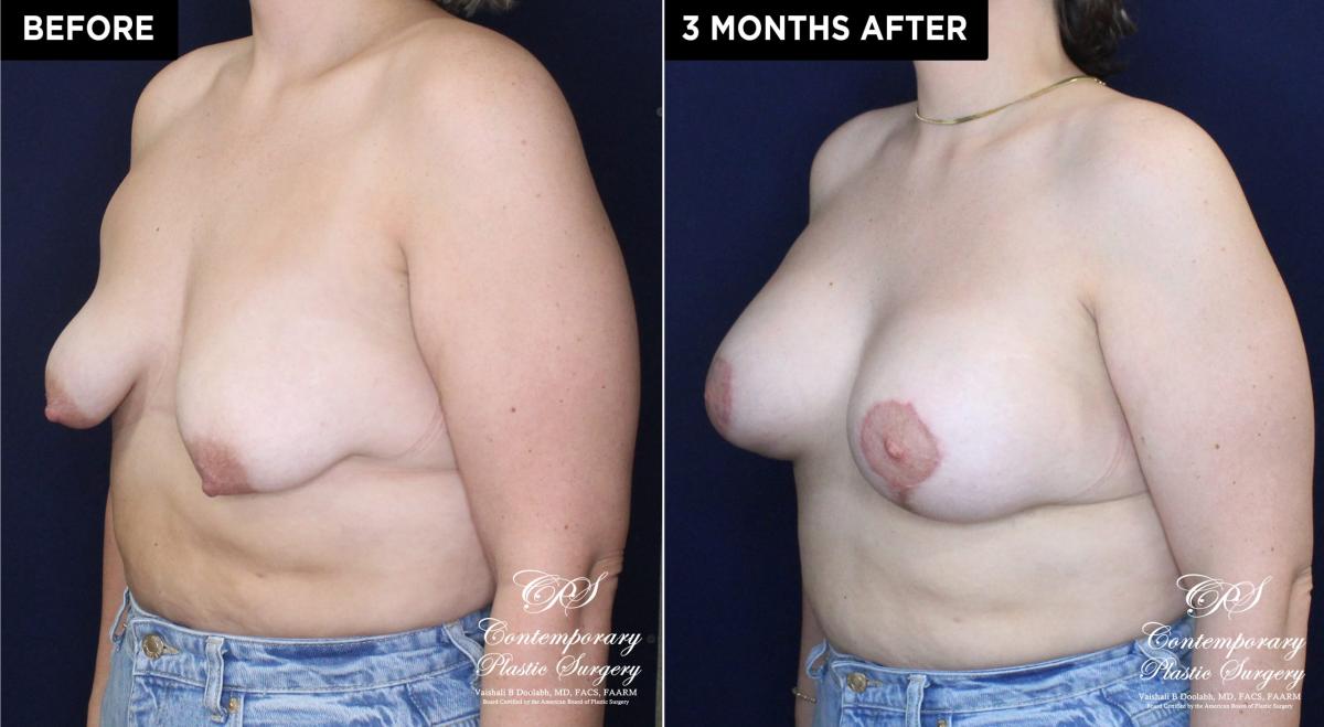 Patient 20074 breast lift with augmentation at Contemporary Plastic Surgery