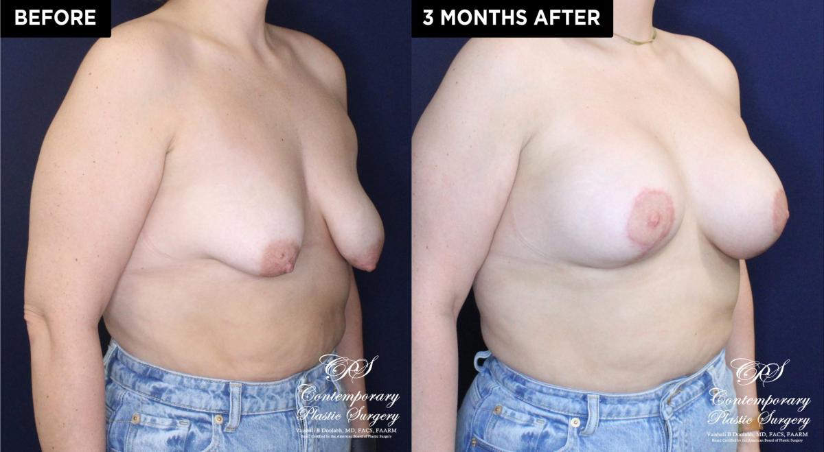 Patient 20074 breast lift with augmentation at Contemporary Plastic Surgery