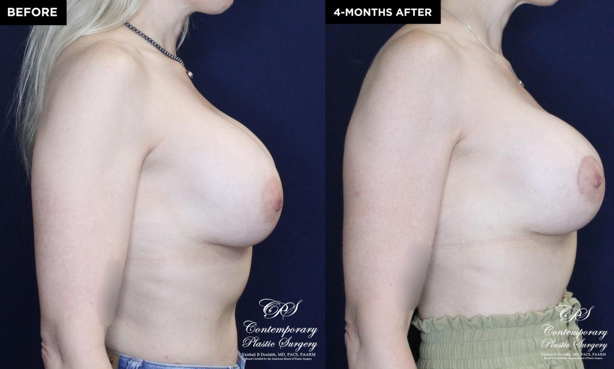 Patient 20137 breast augmentation before and after results at Contemporary Plastic Surgery