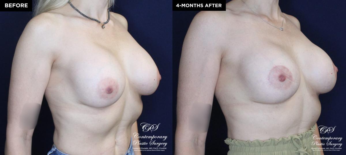 Patient 20137 breast augmentation before and after results at Contemporary Plastic Surgery