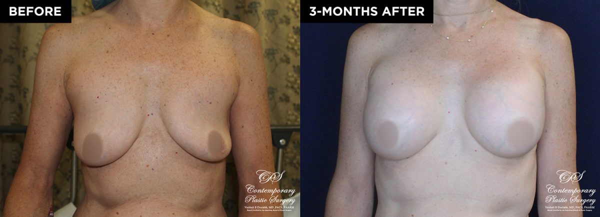 patient 20153 breast augmentation results at Contemporary Plastic Surgery