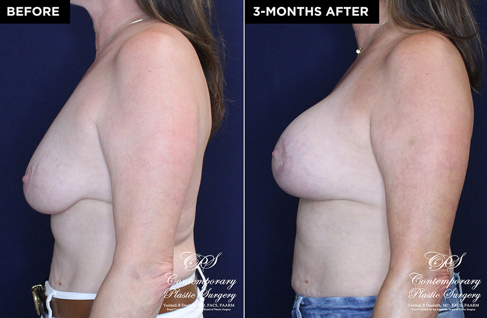 patient #20230 breast lift with implants before and after results at Contemporary Plastic Surgery