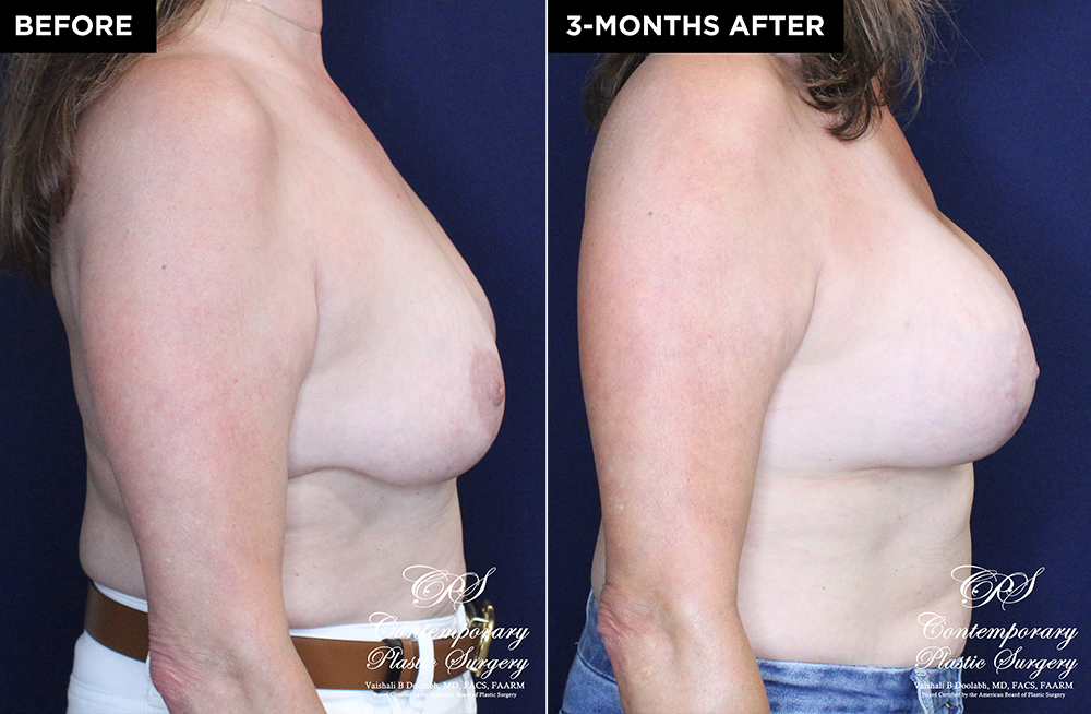 patient #20230 breast lift with implants before and after results at Contemporary Plastic Surgery