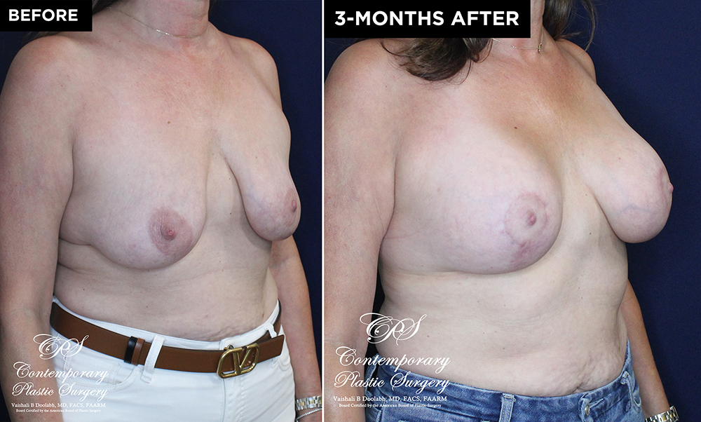 patient #20230 breast lift with implants before and after results at Contemporary Plastic Surgery