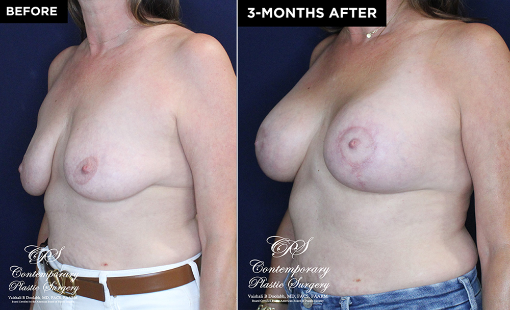 patient #20230 breast lift with implants before and after results at Contemporary Plastic Surgery