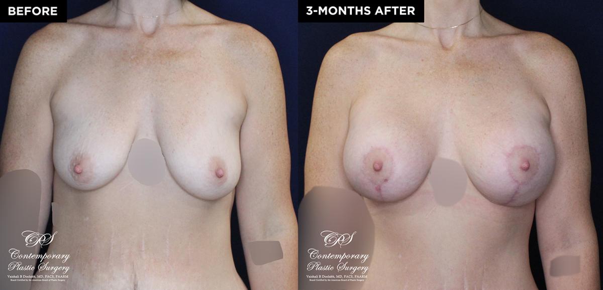 Patient #20360 breast augmentation before and after results at Contemporary Plastic Surgery