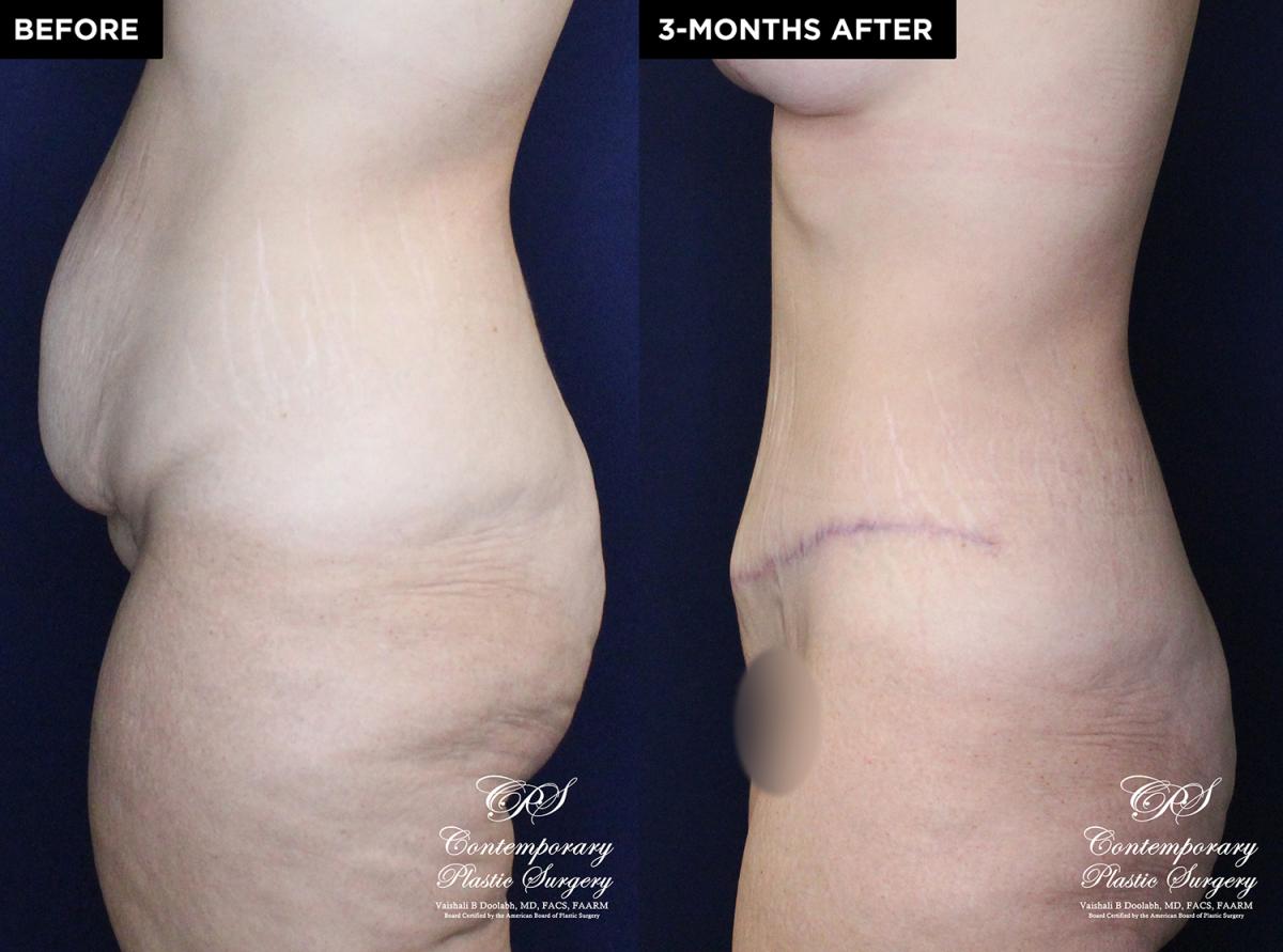 Patient #20360 tummy tuck before and after results at Contemporary Plastic Surgery