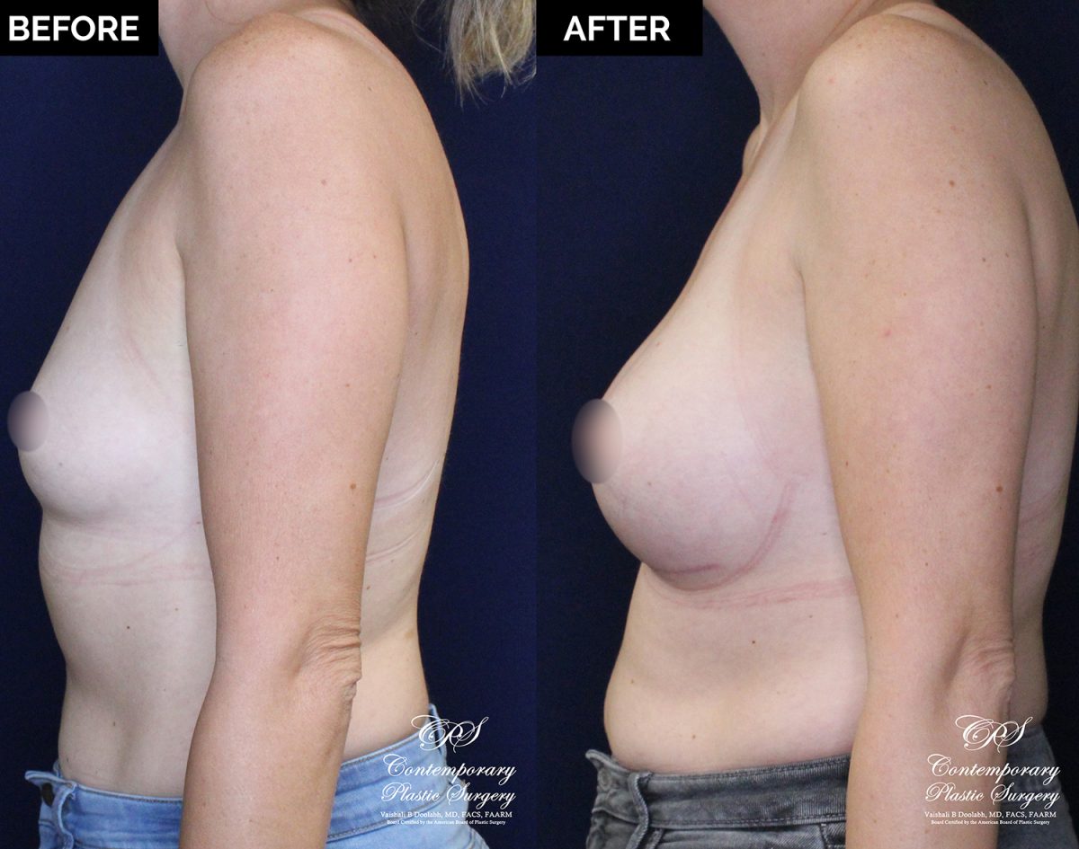 patient 20477 breast augmentation results at Contemporary Plastic Surgery