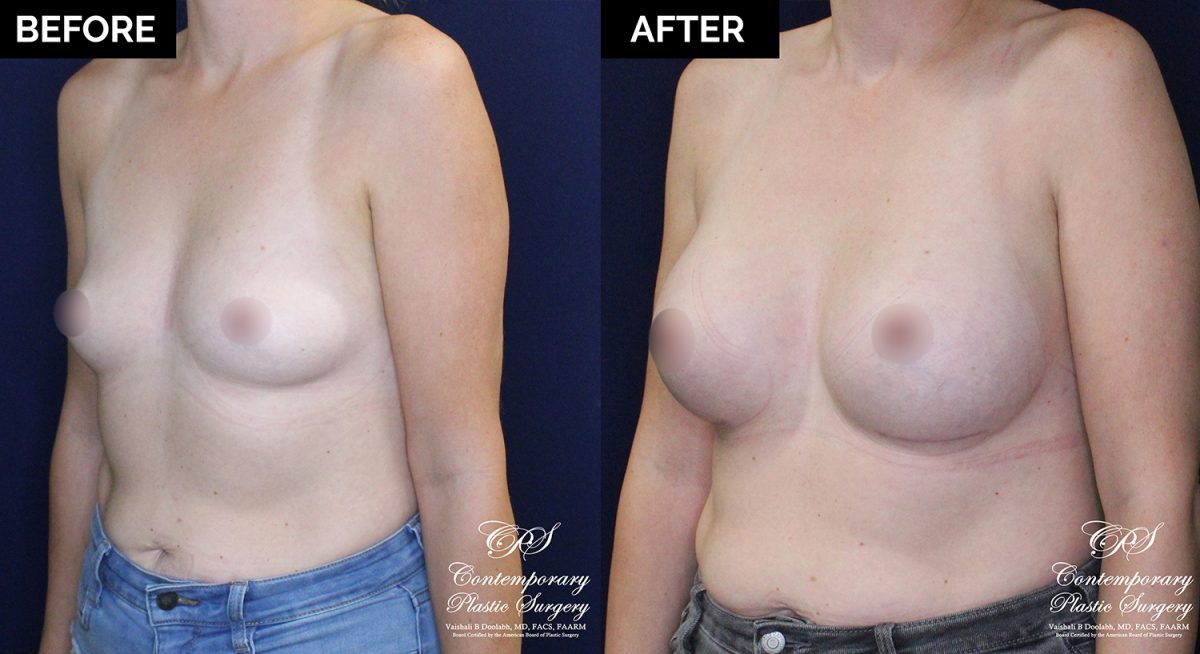 patient 20477 breast augmentation results at Contemporary Plastic Surgery