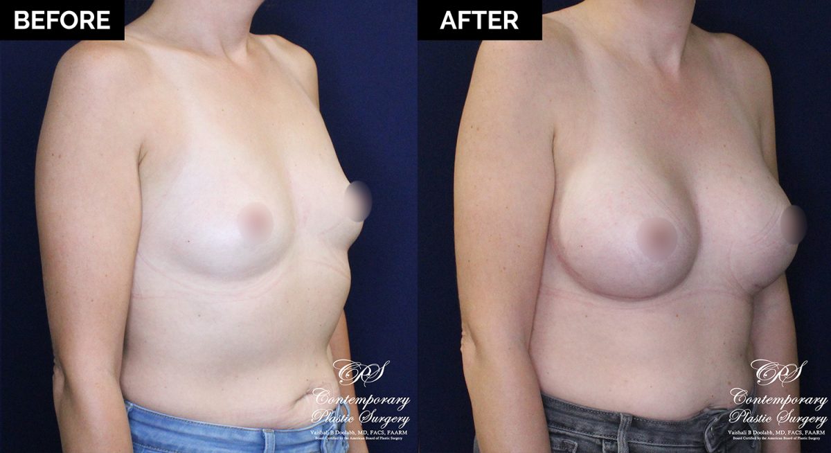 patient 20477 breast augmentation results at Contemporary Plastic Surgery
