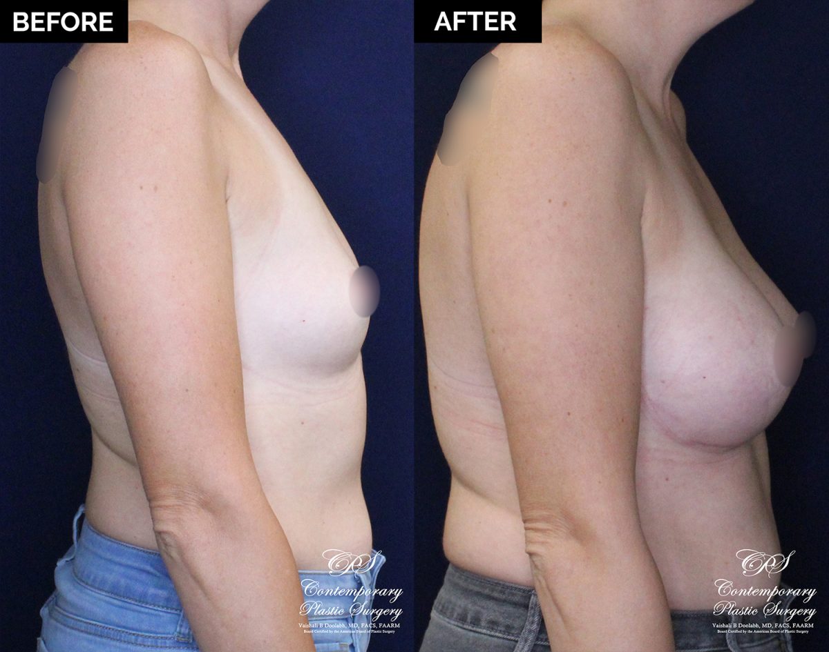patient 20477 breast augmentation results at Contemporary Plastic Surgery