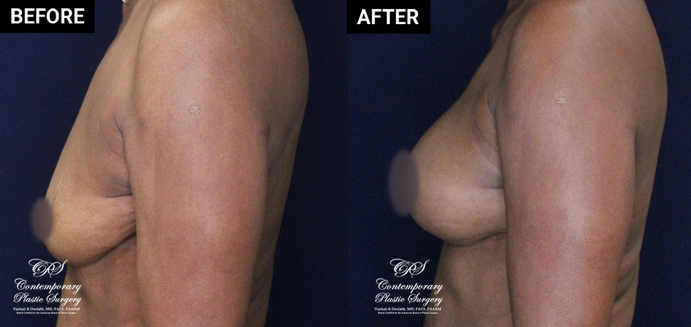 patient 20558 breast augmentation results at Contemporary Plastic Surgery