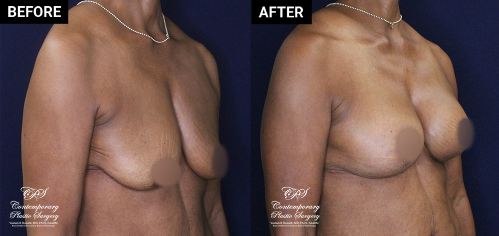 patient 20558 breast augmentation results at Contemporary Plastic Surgery