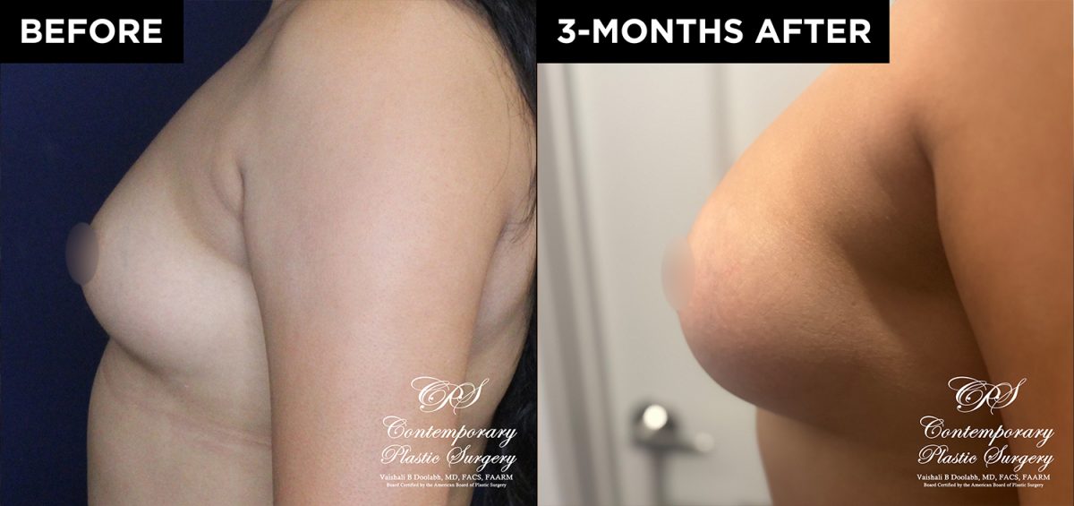 patient 20700 breast augmentation results at Contemporary Plastic Surgery