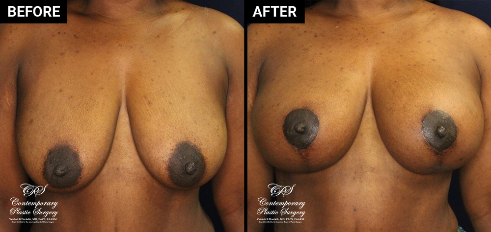 breast augmentation patient results before and after at Contemporary Plastic Surgery