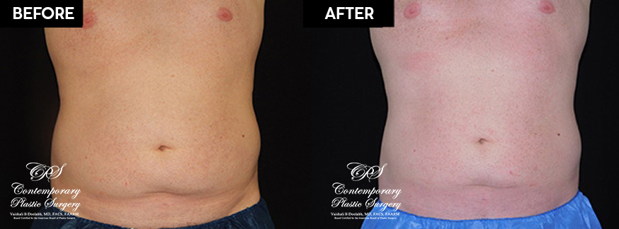 Patient's before and after results from CoolSculpting treatment at Contemporary Plastic Surgery