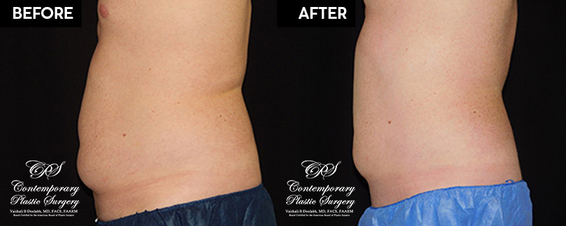 Patient's before and after results from CoolSculpting treatment at Contemporary Plastic Surgery