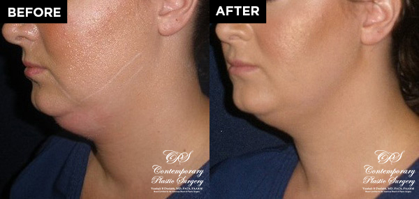 patient results before & after Kybella injections at Contemporary Plastic Surgery