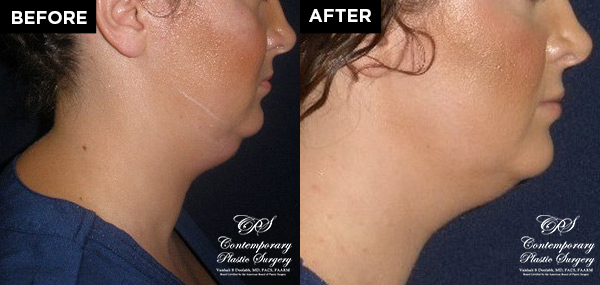 patient results before & after Kybella injections at Contemporary Plastic Surgery