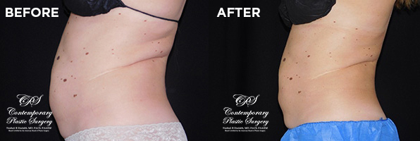 Patient's before and after results from CoolSculpting treatment at Contemporary Plastic Surgery