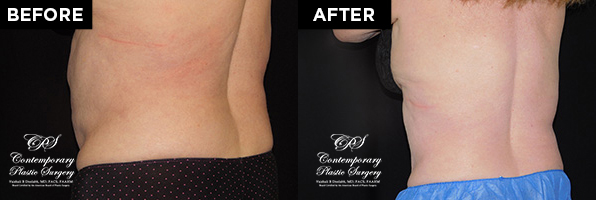 Patient's before and after results from CoolSculpting treatment at Contemporary Plastic Surgery