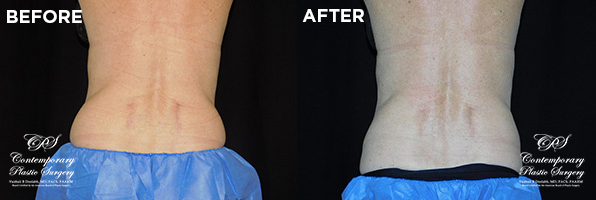 Patient's before and after results from CoolSculpting treatment at Contemporary Plastic Surgery