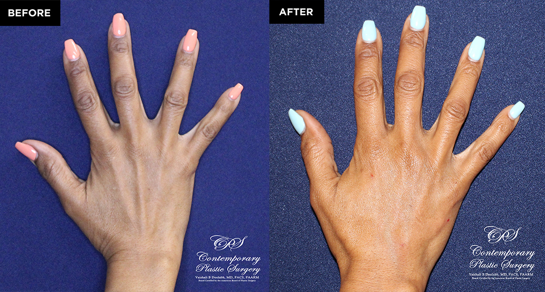patient before and after results of Radiesse injectable treatment in the back of hands at Contemporary Plastic Surgery