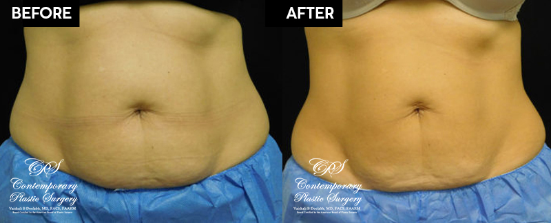 Patient's before and after results from CoolSculpting treatment at Contemporary Plastic Surgery